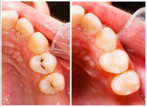 Before and after Tooth-colored fillings illustration