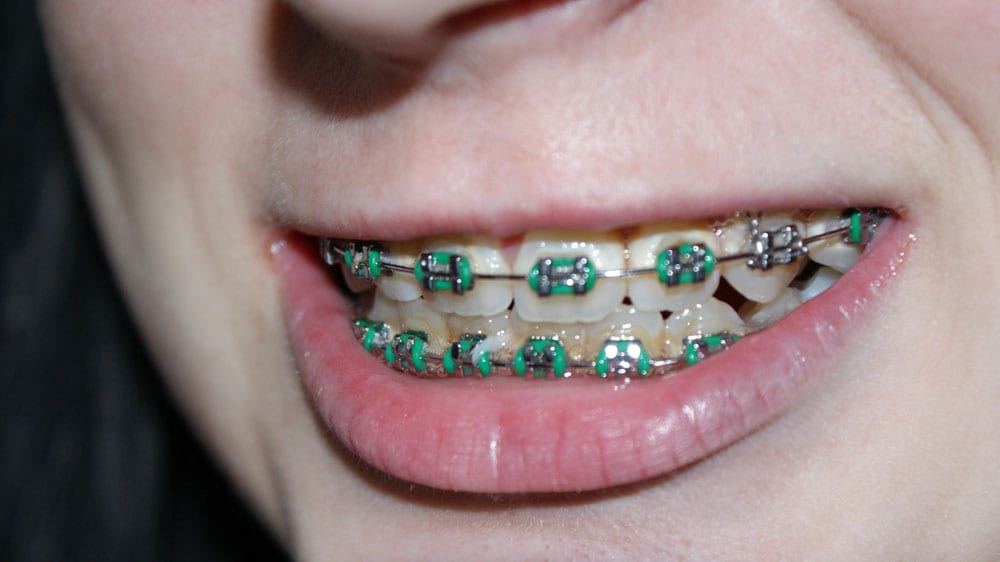 Managing Pain and Soreness From Braces