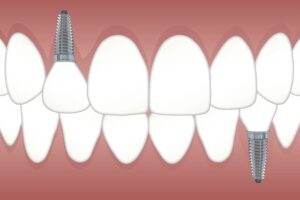 How Long Will Your Dental Implants Last