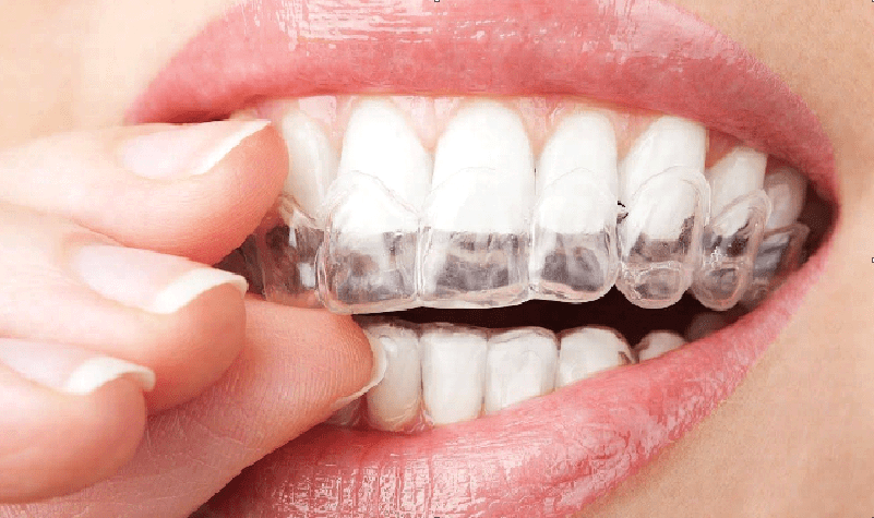 Know what is the best way to whiten the teeth